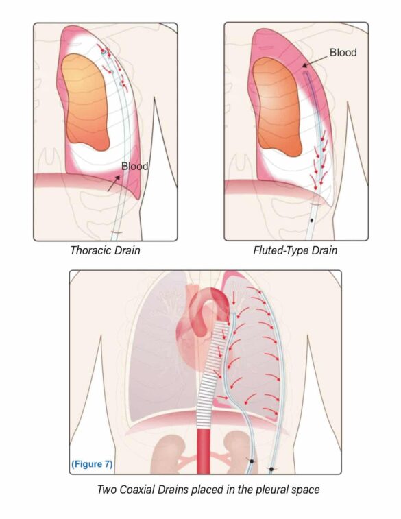 Study Concludes the Coaxial Thoracic Drain Contributes to Improving ...