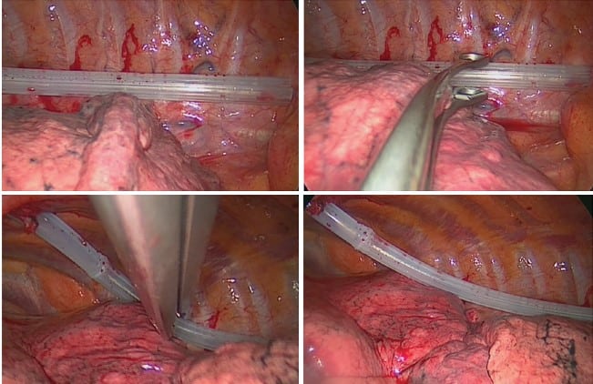 Coaxial Drain placement during VATS procedure